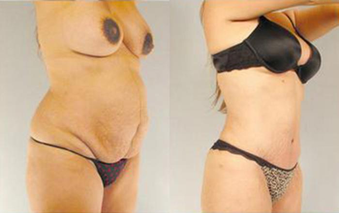 Before & After Tummy Tuck Case 27 View 2 View in Houston, TX