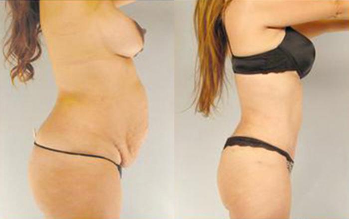 Before & After Tummy Tuck Case 27 View 3 View in Houston, TX