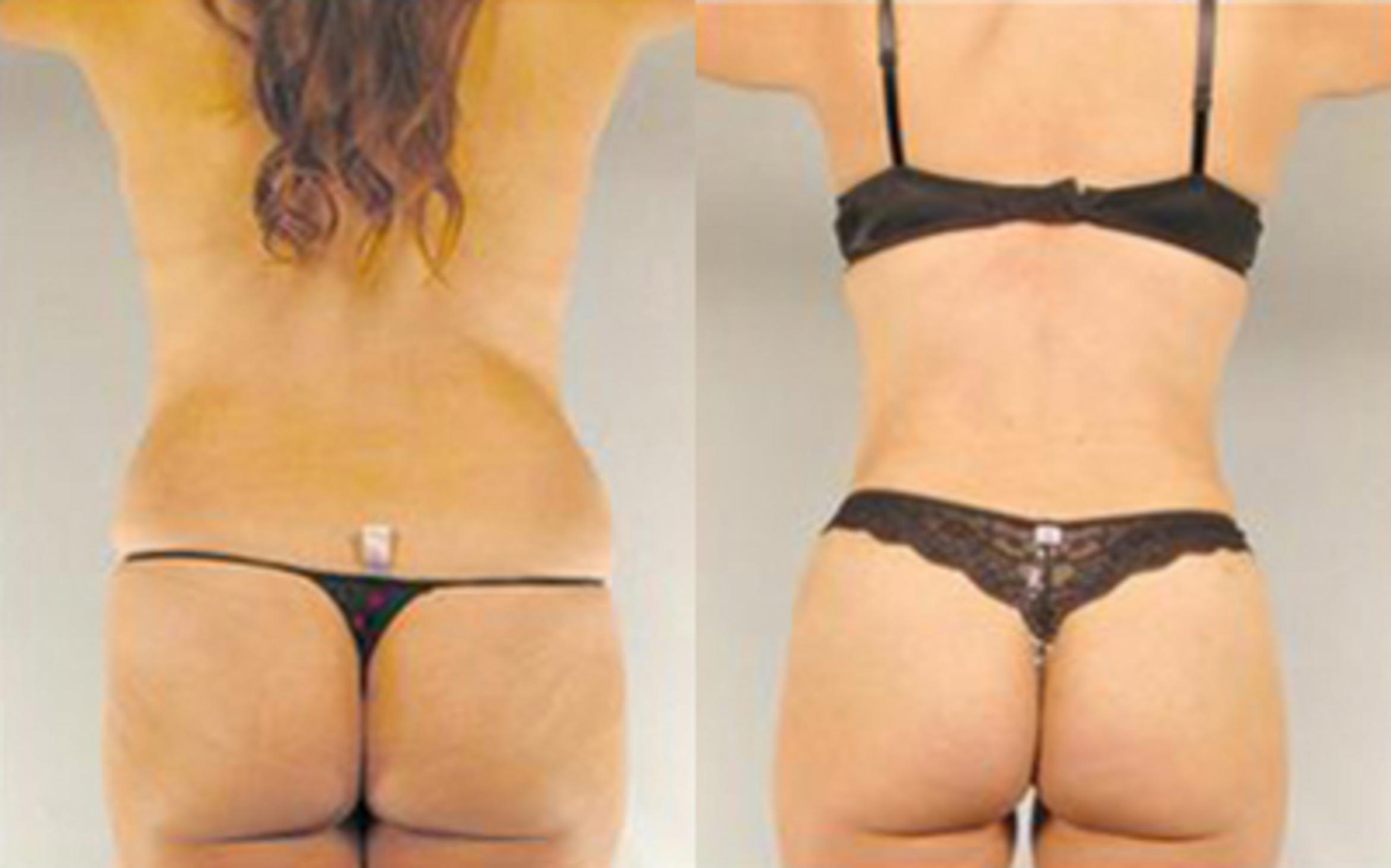 Before & After Tummy Tuck Case 27 View 4 View in Houston, TX