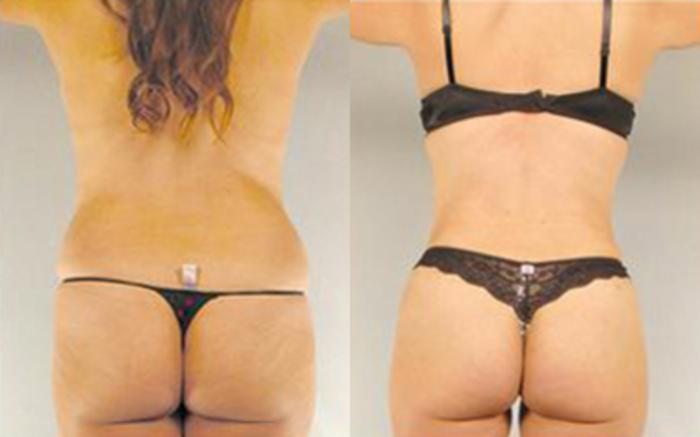 Before & After Tummy Tuck Case 27 View 4 View in Houston, TX