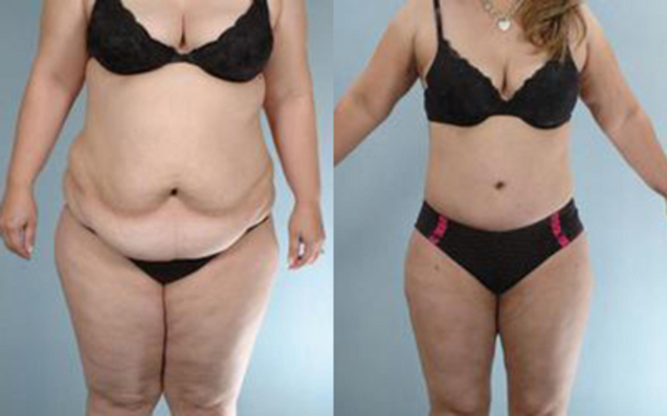 Before & After Tummy Tuck Case 28 View 1 View in Houston, TX
