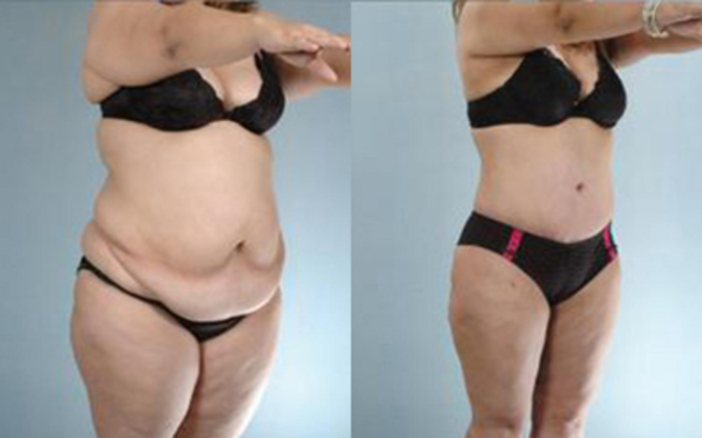 Before & After Tummy Tuck Case 28 View 2 View in Houston, TX