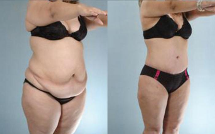 Before & After Tummy Tuck Case 28 View 2 View in Houston, TX