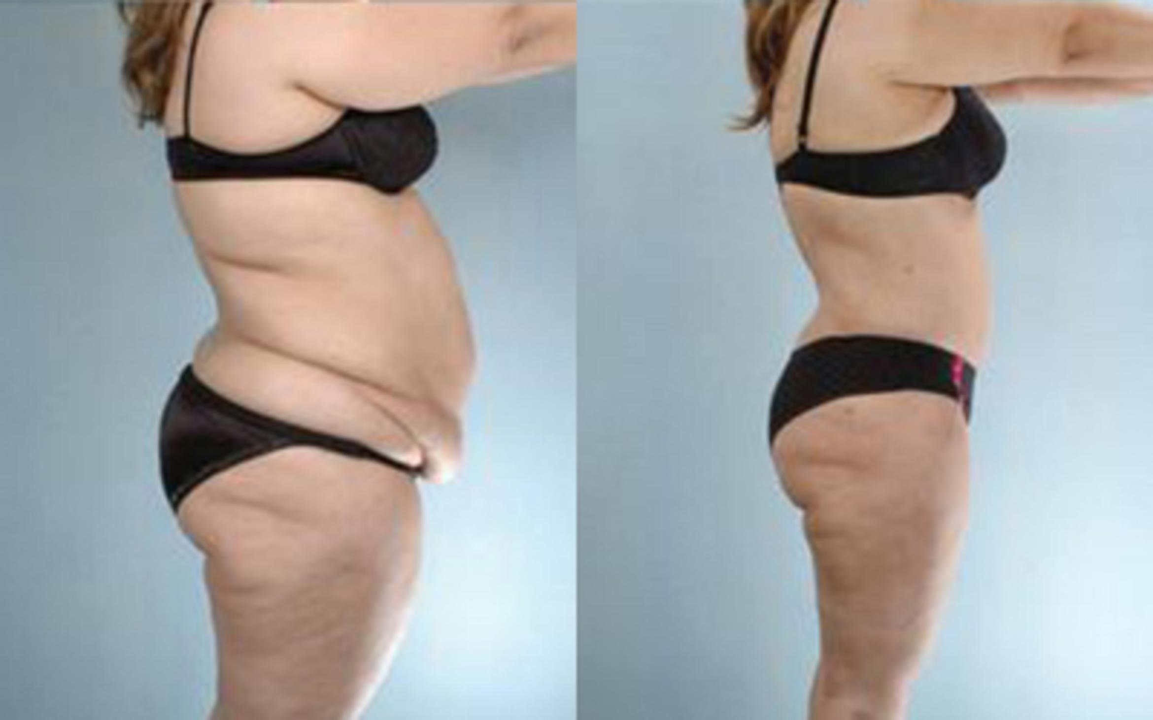 Before & After Tummy Tuck Case 28 View 3 View in Houston, TX