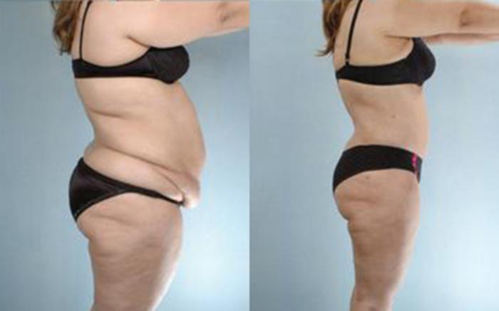 Before & After Tummy Tuck Case 28 View 3 View in Houston, TX