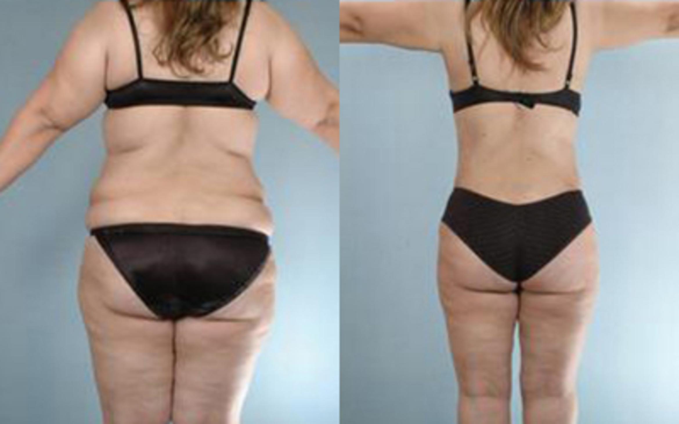 Before & After Tummy Tuck Case 28 View 4 View in Houston, TX