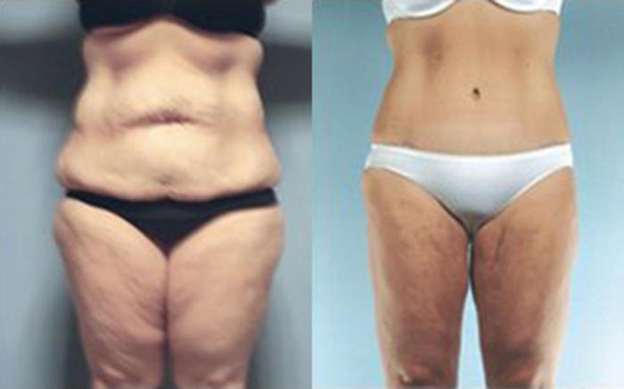 Before & After Tummy Tuck Case 29 View 1 View in Houston, TX
