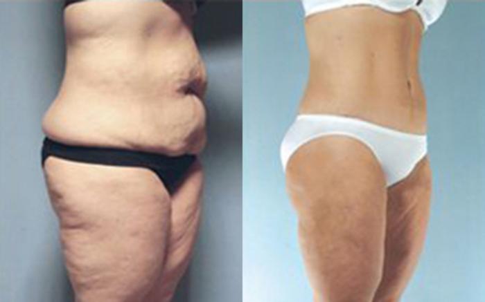 Before & After Tummy Tuck Case 29 View 2 View in Houston, TX