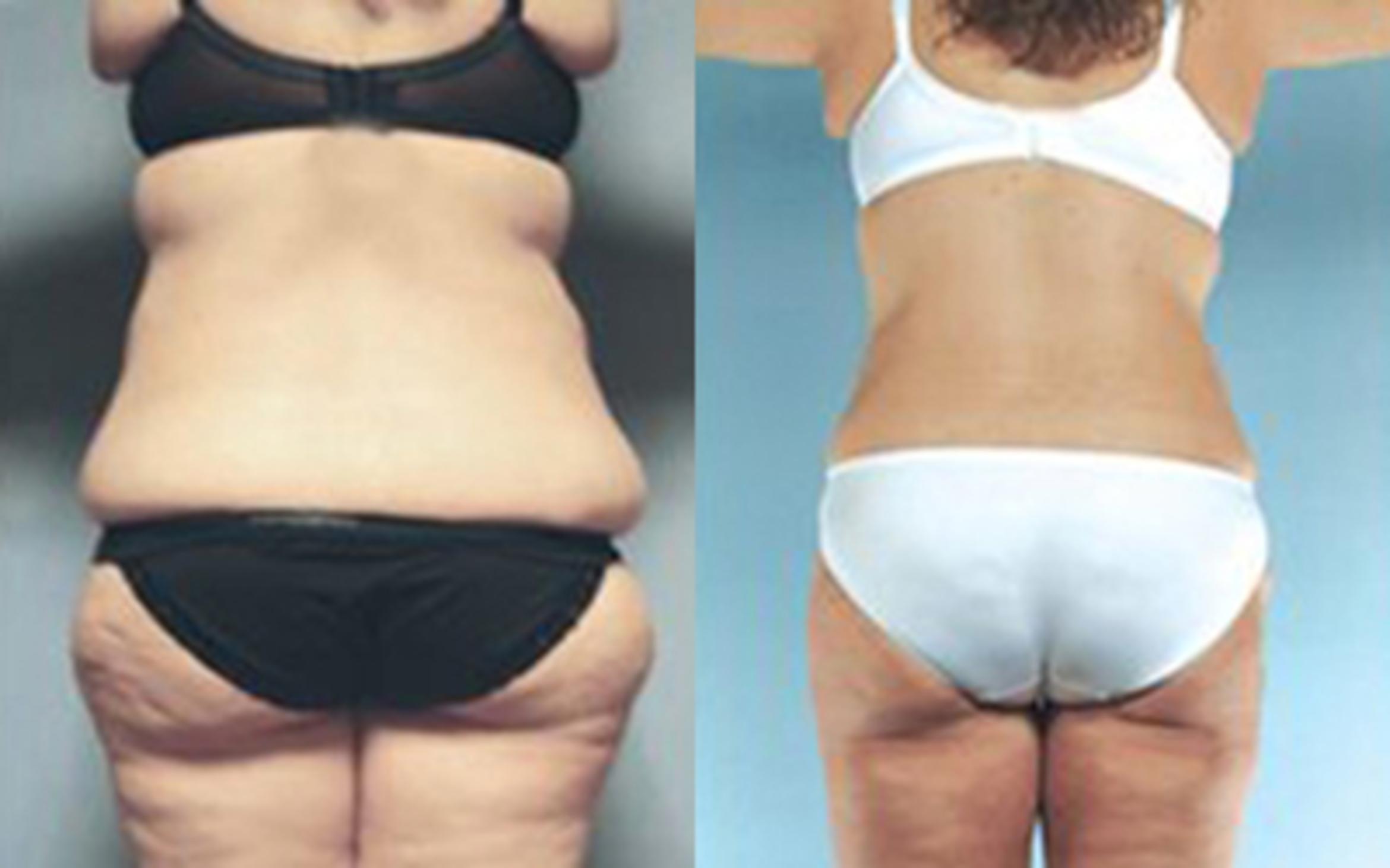 Before & After Tummy Tuck Case 29 View 3 View in Houston, TX