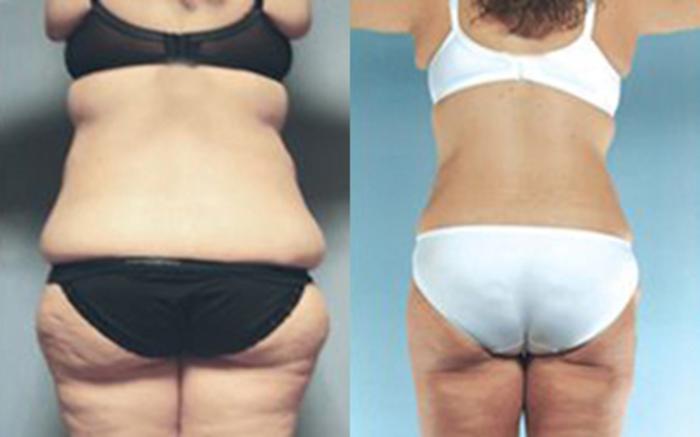Before & After Tummy Tuck Case 29 View 3 View in Houston, TX