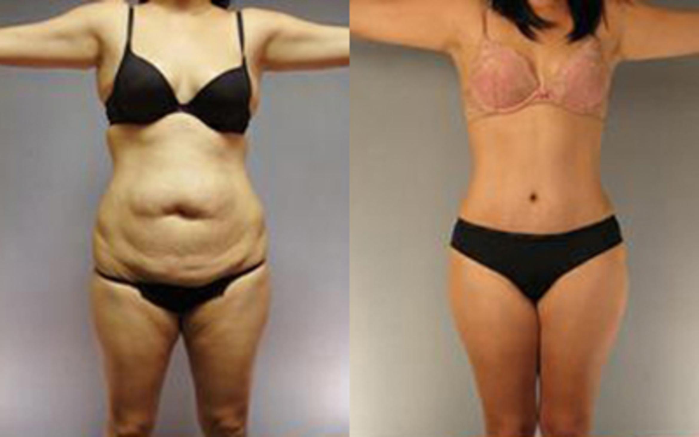 Before & After Tummy Tuck Case 3 View 1 View in Houston, TX