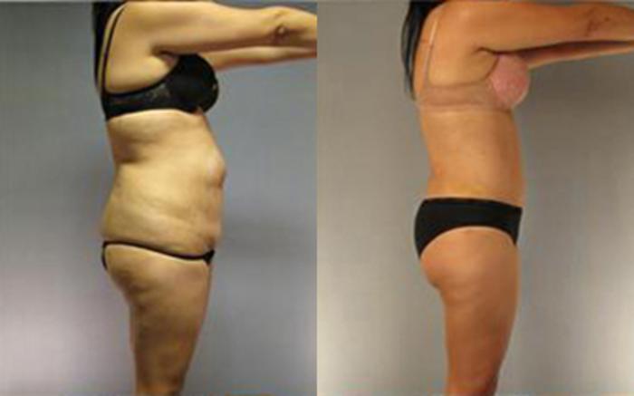 Before & After Tummy Tuck Case 3 View 2 View in Houston, TX