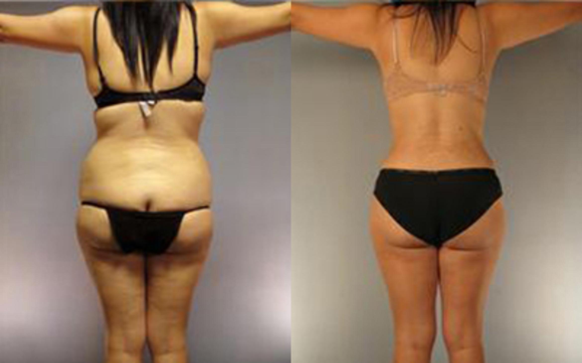 Before & After Tummy Tuck Case 3 View 3 View in Houston, TX