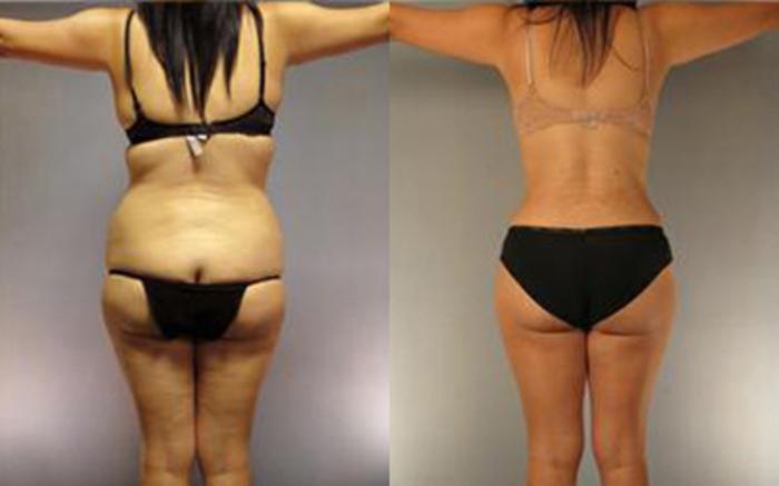 Before & After Tummy Tuck Case 3 View 3 View in Houston, TX