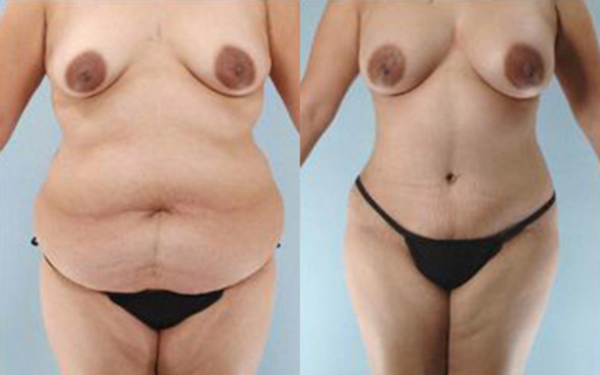 Before & After Tummy Tuck Case 30 View 1 View in Houston, TX