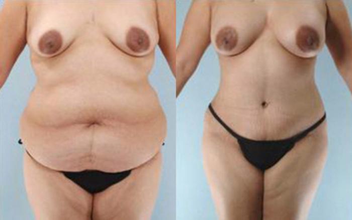 Before & After Tummy Tuck Case 30 View 1 View in Houston, TX