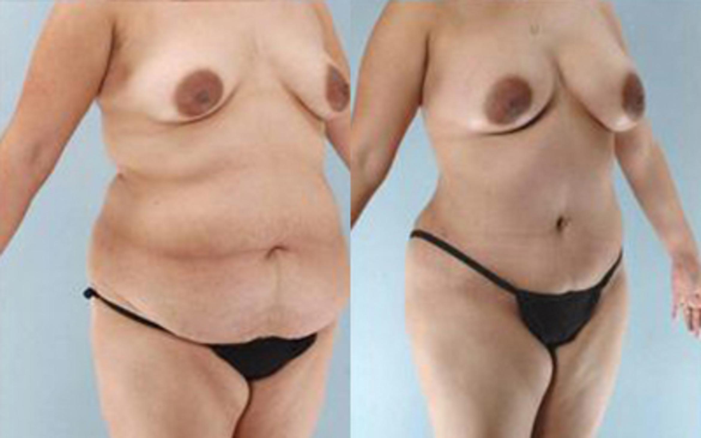 Before & After Tummy Tuck Case 30 View 2 View in Houston, TX