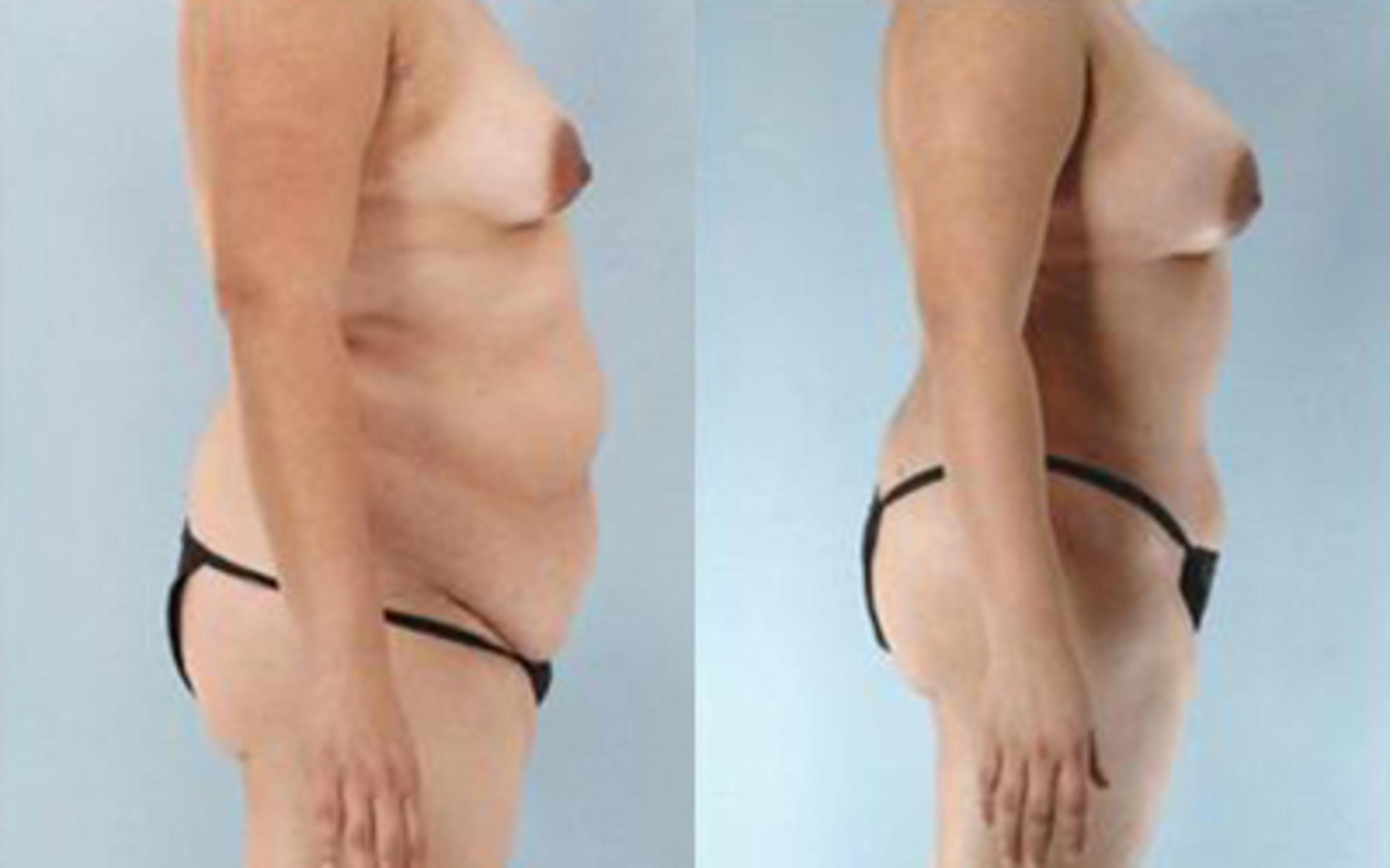 Before & After Tummy Tuck Case 30 View 3 View in Houston, TX