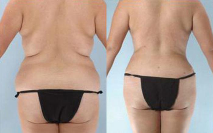 Before & After Tummy Tuck Case 30 View 4 View in Houston, TX