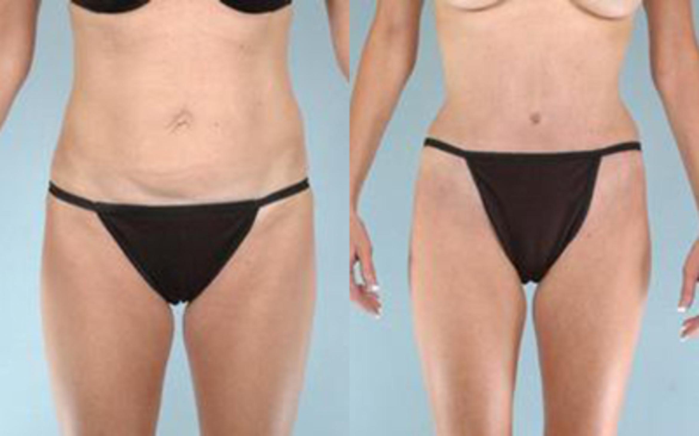 Before & After Tummy Tuck Case 31 View 1 View in Houston, TX