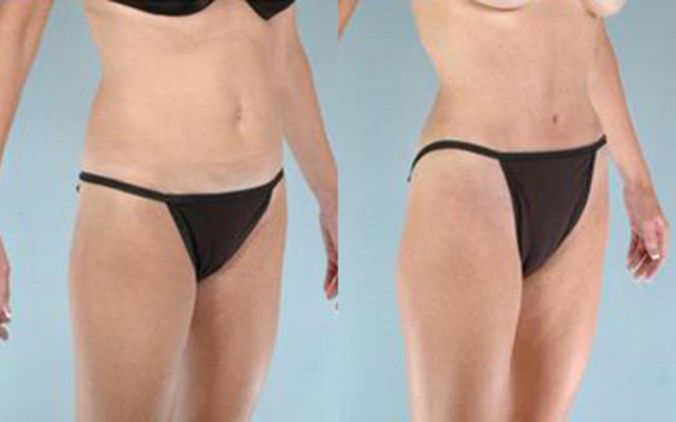 Before & After Tummy Tuck Case 31 View 2 View in Houston, TX