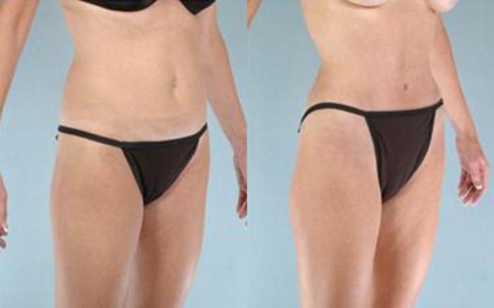 Before & After Tummy Tuck Case 31 View 2 View in Houston, TX