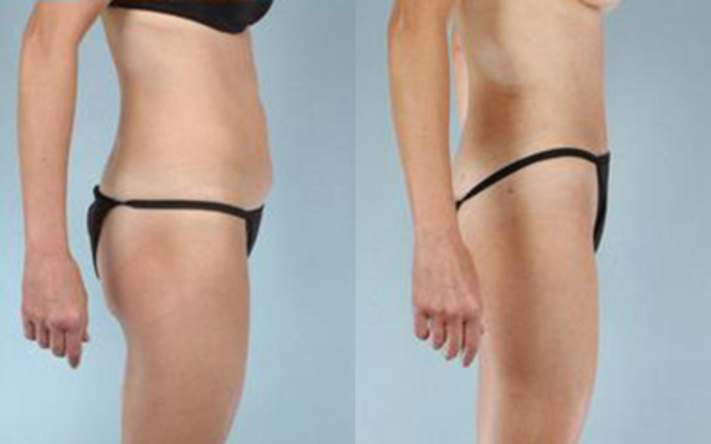 Before & After Tummy Tuck Case 31 View 3 View in Houston, TX