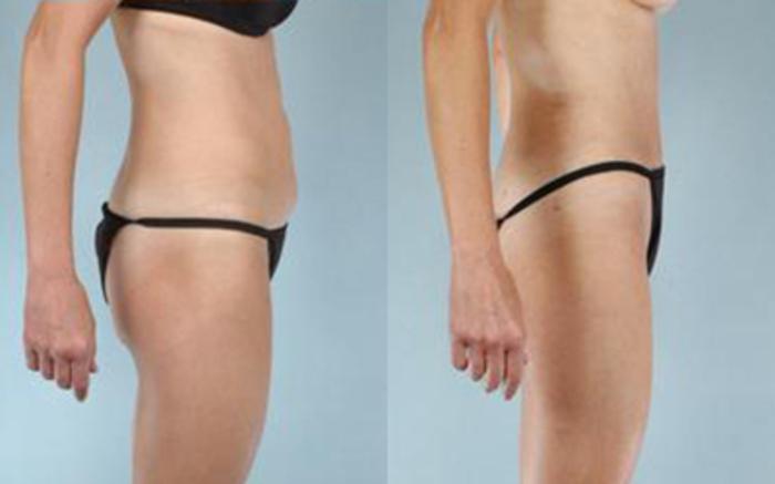 Before & After Tummy Tuck Case 31 View 3 View in Houston, TX