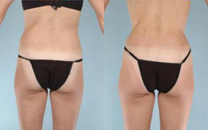 Before & After Tummy Tuck Case 31 View 4 View in Houston, TX