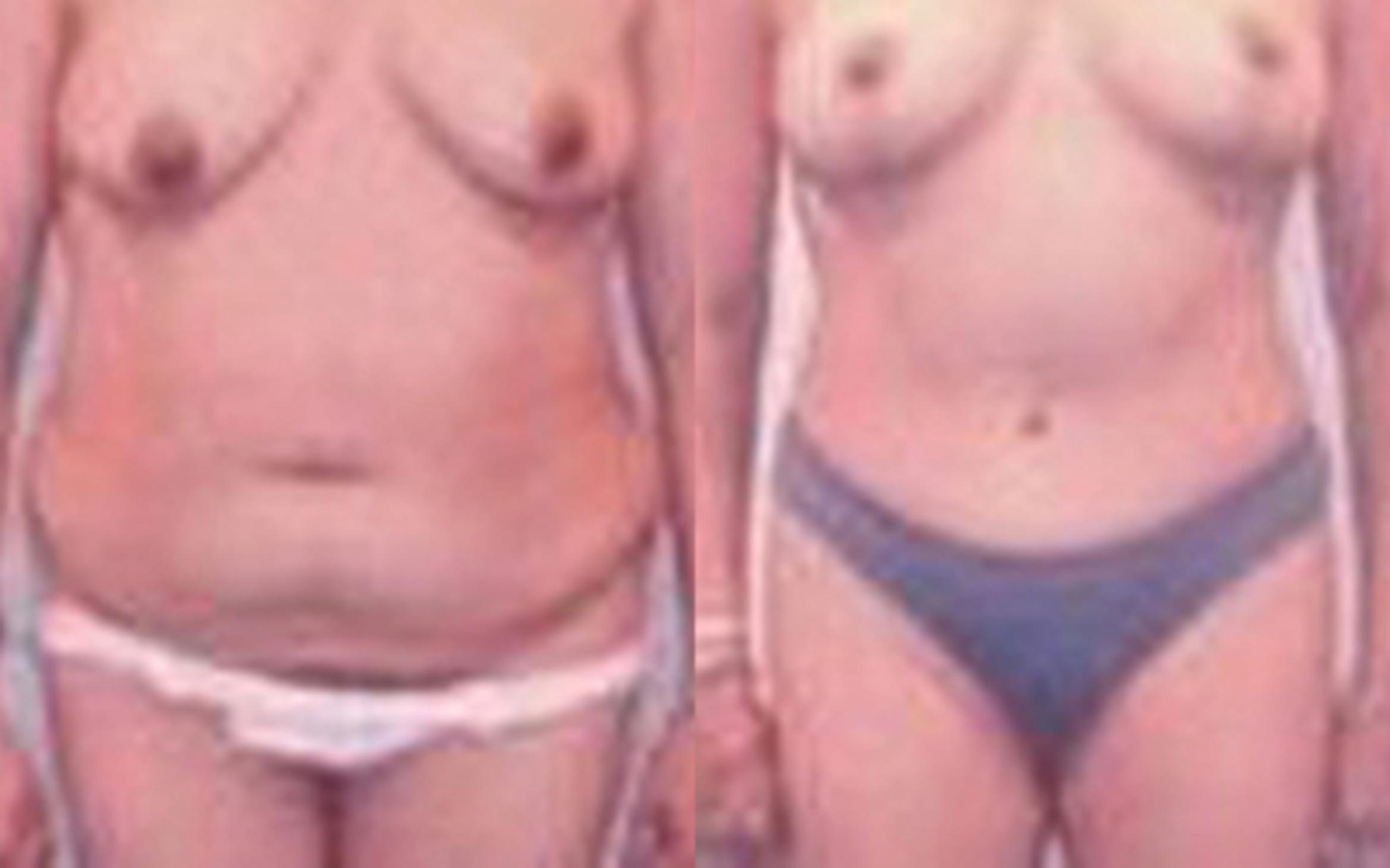 Before & After Tummy Tuck Case 32 View 1 View in Houston, TX