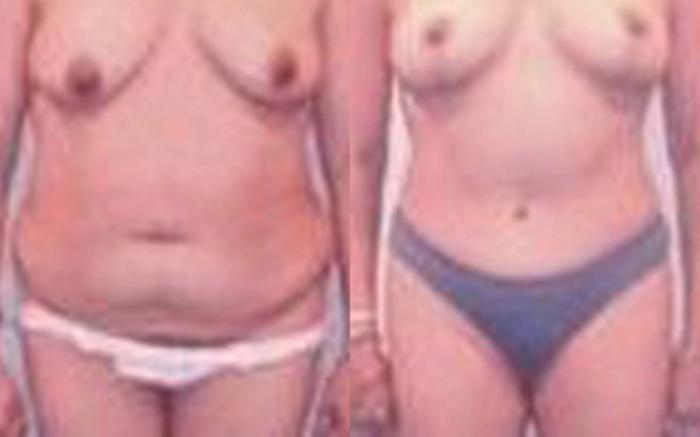Before & After Tummy Tuck Case 32 View 1 View in Houston, TX