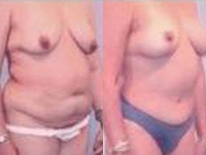 Before & After Tummy Tuck Case 32 View 2 View in Houston, TX