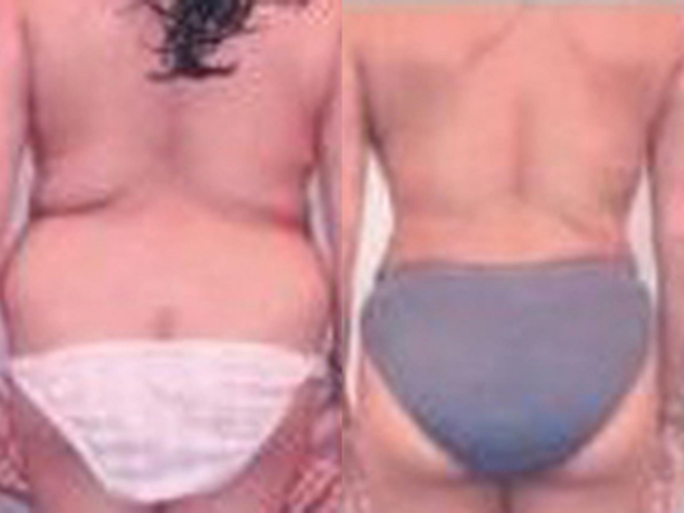 Before & After Tummy Tuck Case 32 View 3 View in Houston, TX