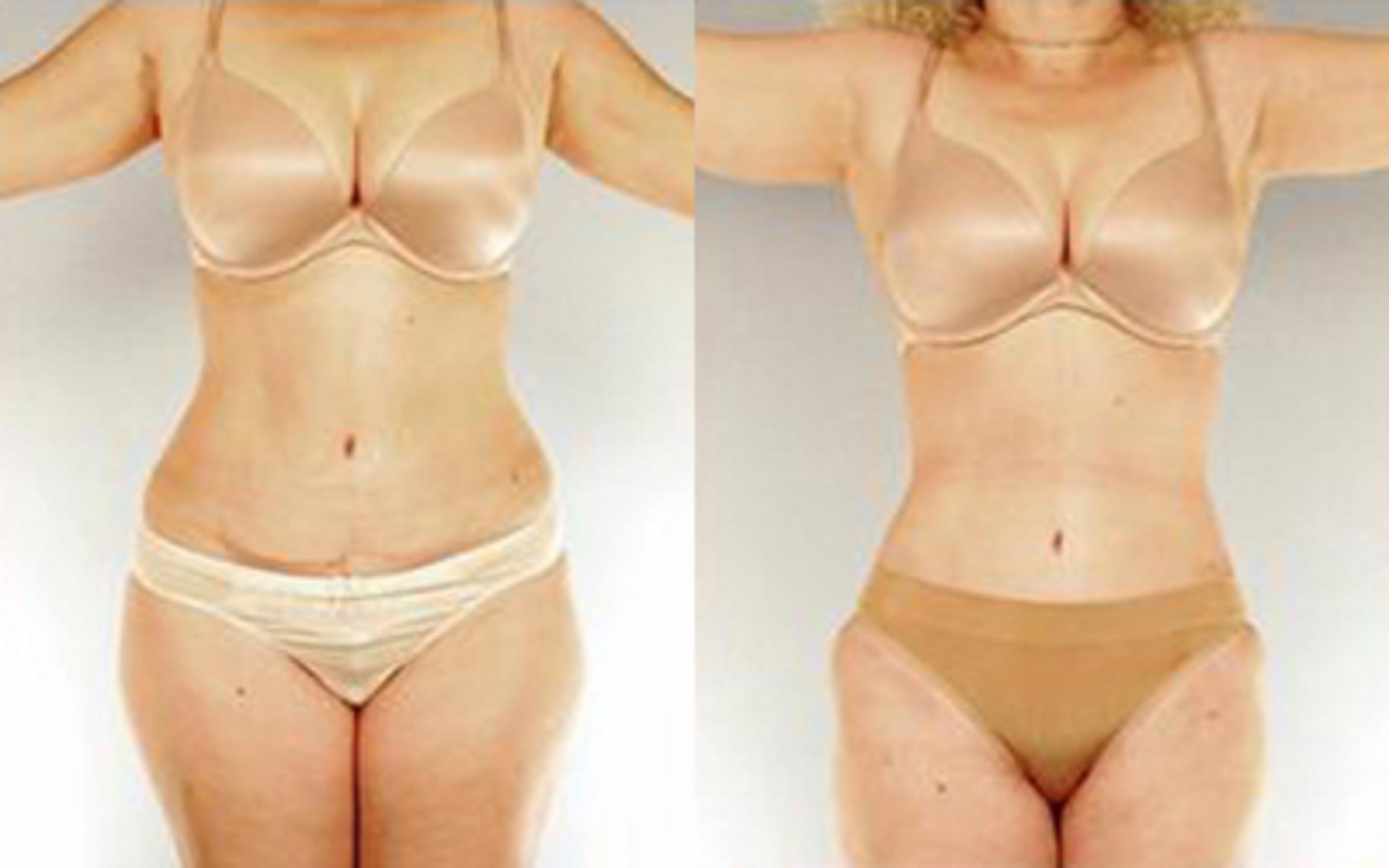 Before & After Tummy Tuck Case 33 View 1 View in Houston, TX
