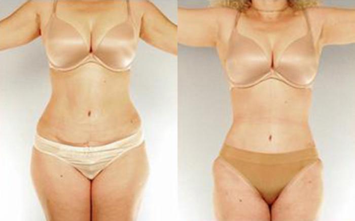 Before & After Tummy Tuck Case 33 View 1 View in Houston, TX