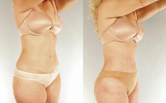 Before & After Tummy Tuck Case 33 View 2 View in Houston, TX
