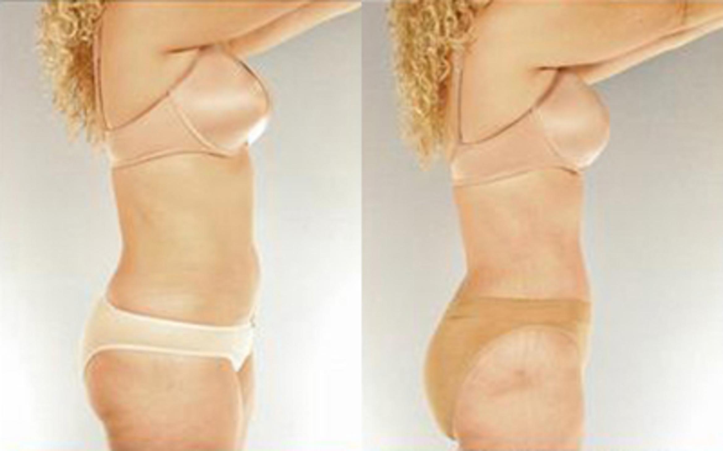 Before & After Tummy Tuck Case 33 View 3 View in Houston, TX