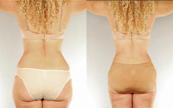 Before & After Tummy Tuck Case 33 View 4 View in Houston, TX