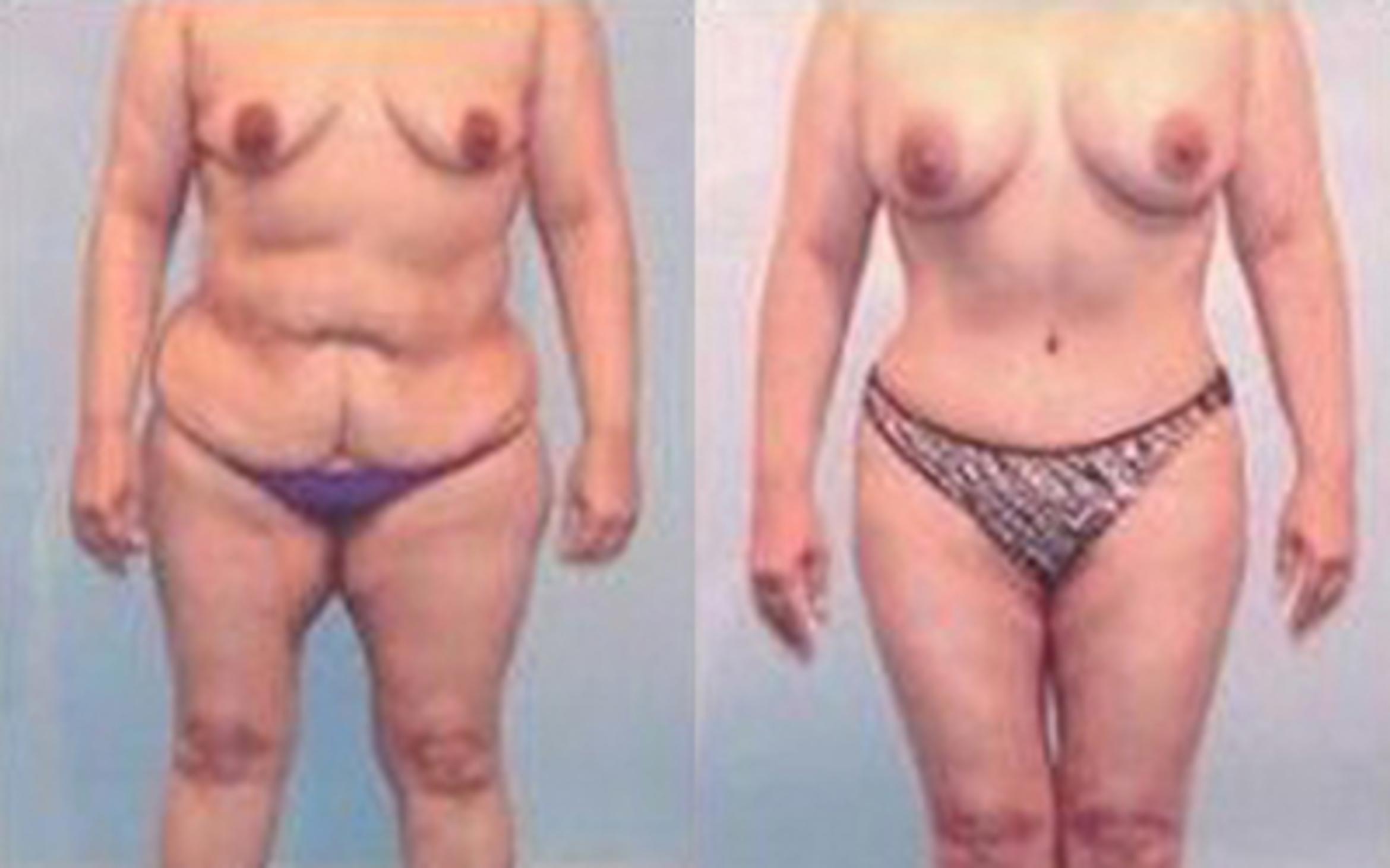 Before & After Tummy Tuck Case 34 View 1 View in Houston, TX