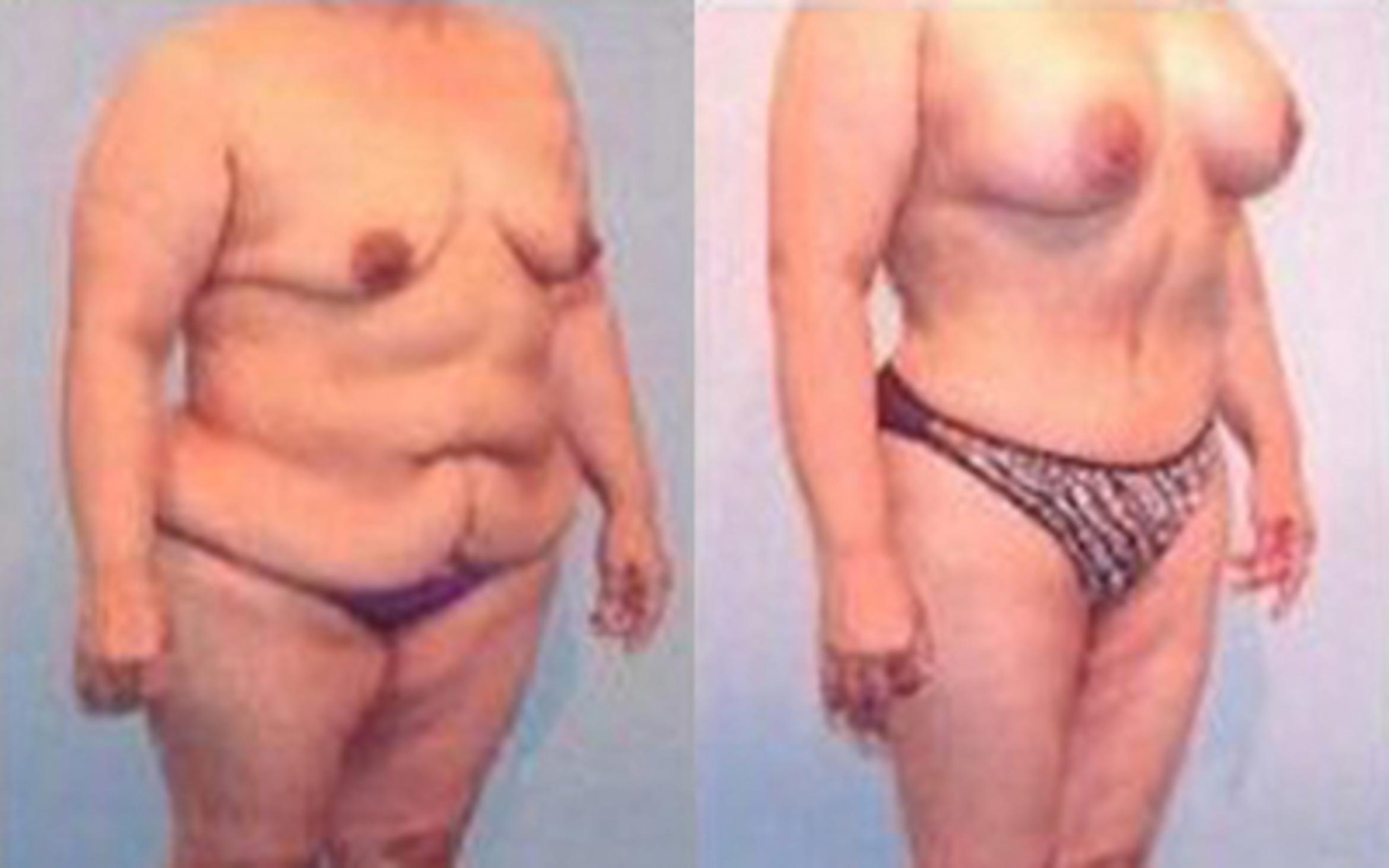 Before & After Tummy Tuck Case 34 View 2 View in Houston, TX