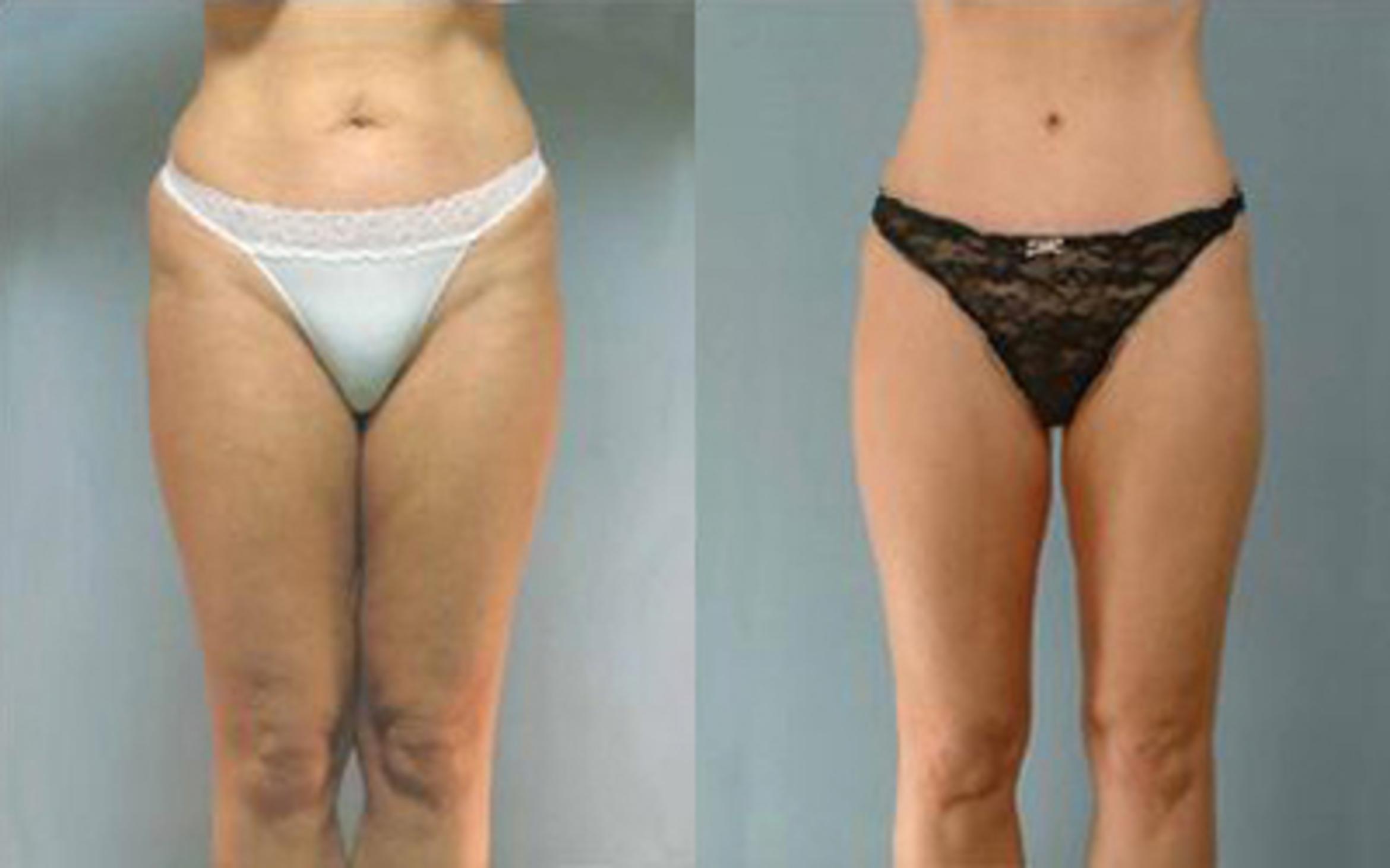 Before & After Tummy Tuck Case 35 View 1 View in Houston, TX