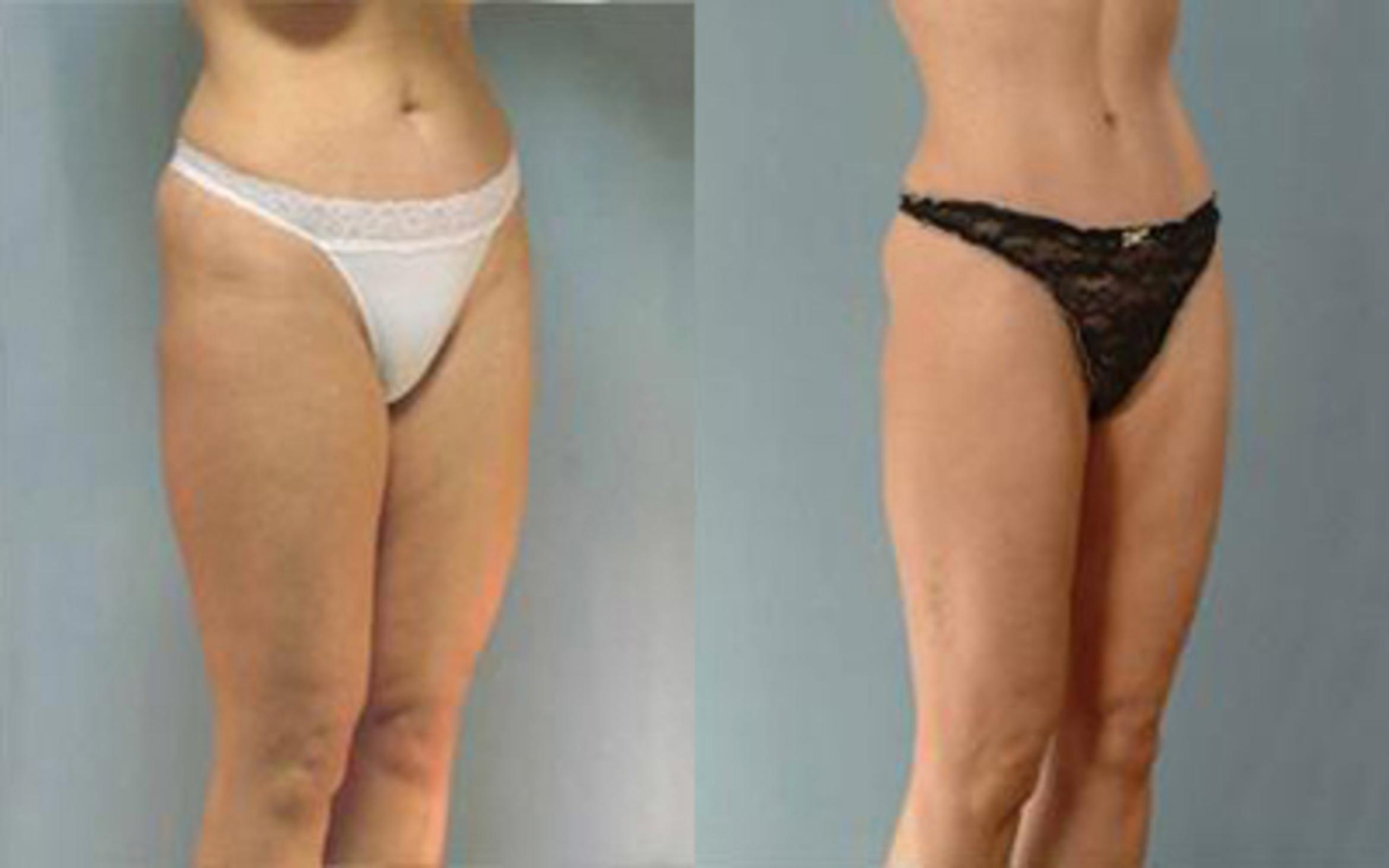 Before & After Tummy Tuck Case 35 View 2 View in Houston, TX