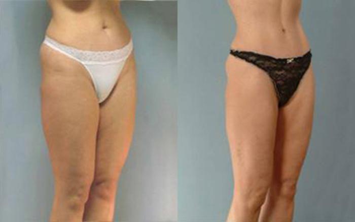 Before & After Tummy Tuck Case 35 View 2 View in Houston, TX