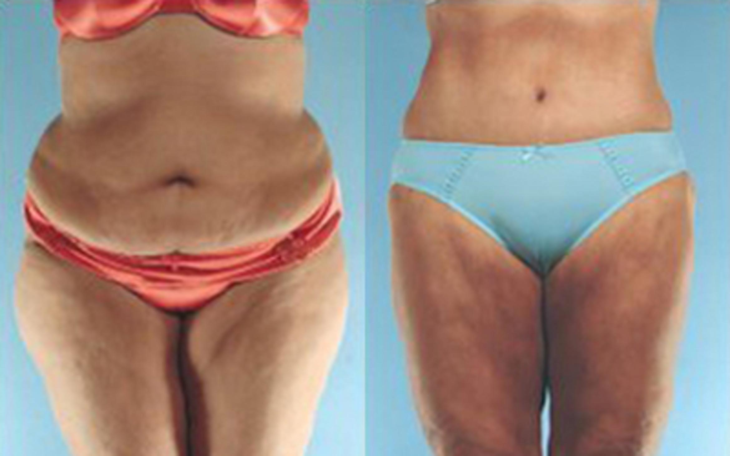 Before & After Tummy Tuck Case 36 View 1 View in Houston, TX