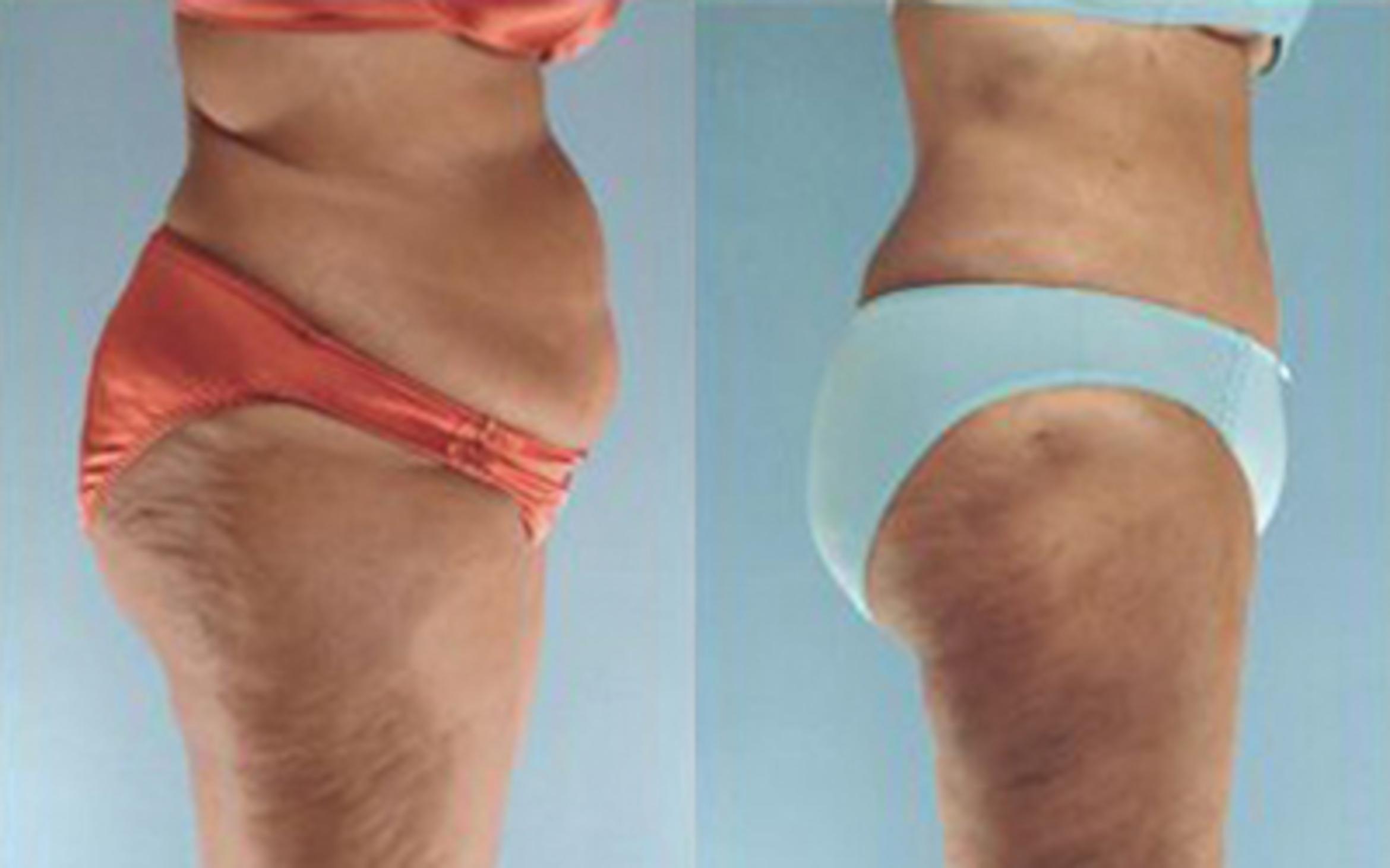 Before & After Tummy Tuck Case 36 View 2 View in Houston, TX