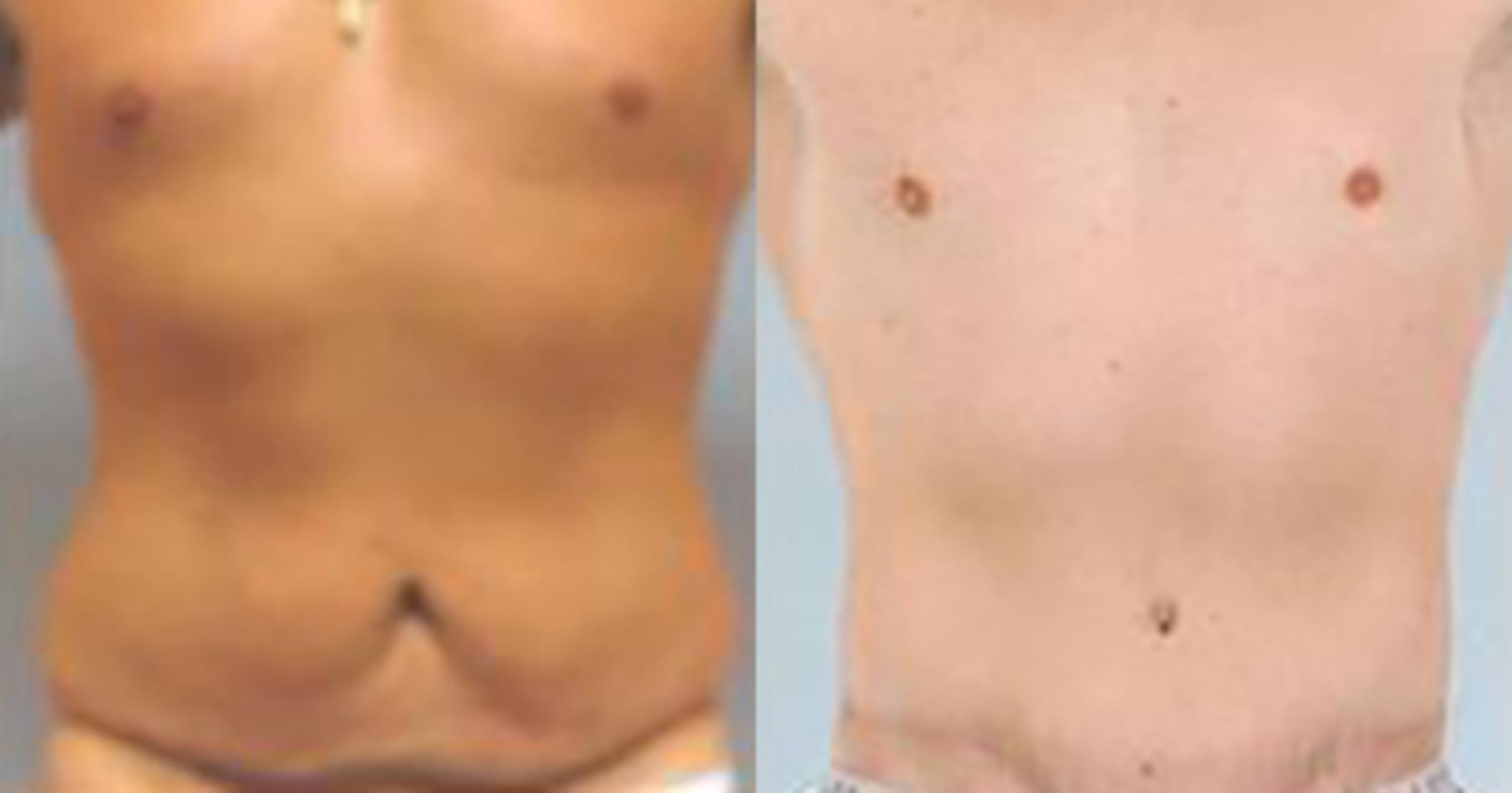 Before & After Tummy Tuck Case 362 View 1 View in Houston, TX