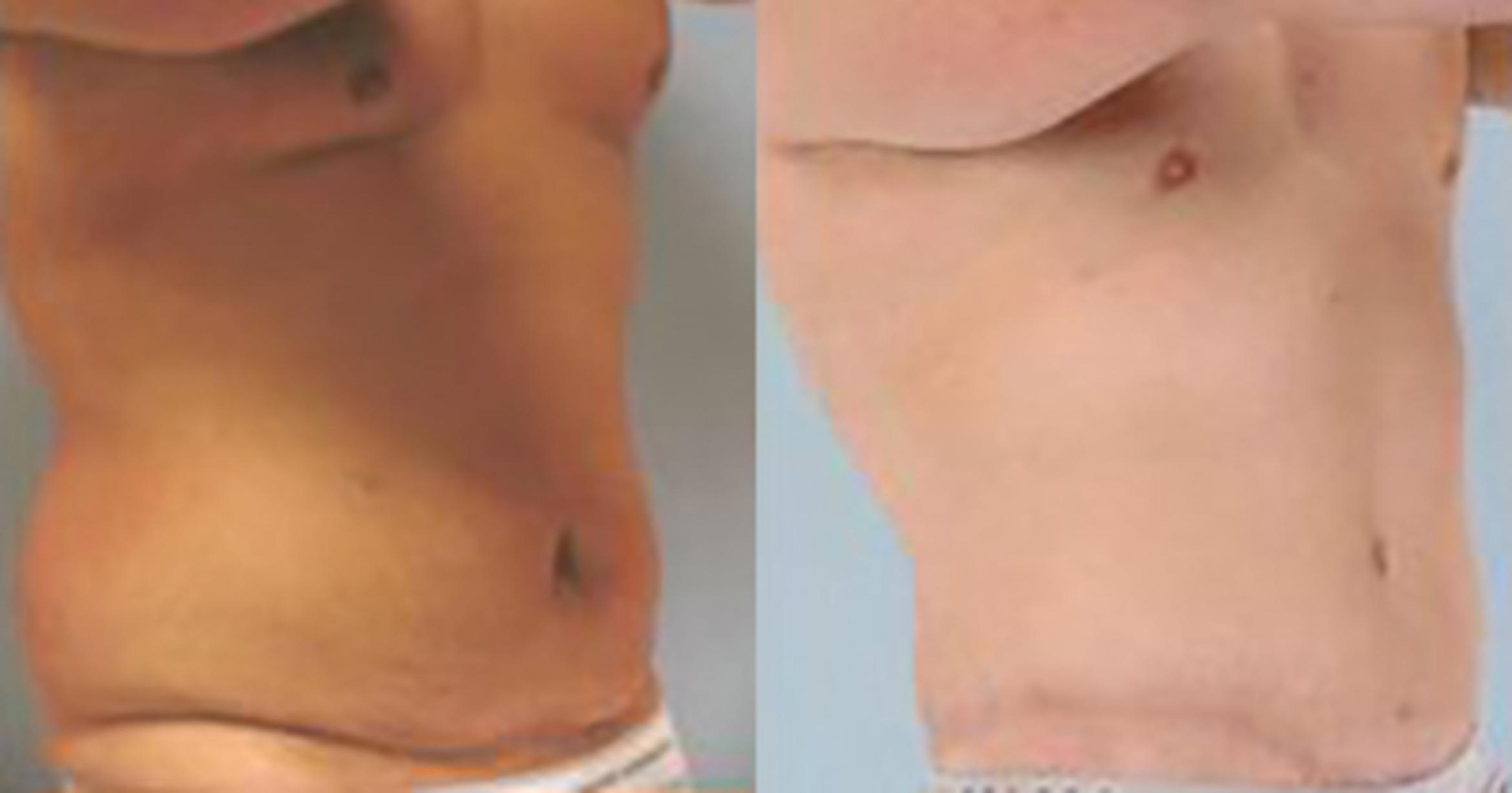Before & After Tummy Tuck Case 362 View 2 View in Houston, TX