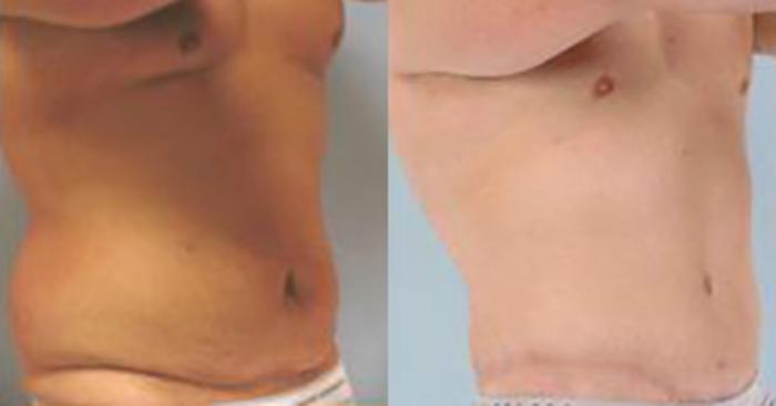Before & After Tummy Tuck Case 362 View 2 View in Houston, TX