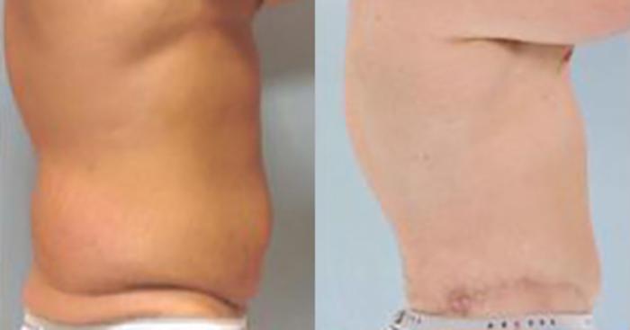 Before & After Tummy Tuck Case 362 View 3 View in Houston, TX