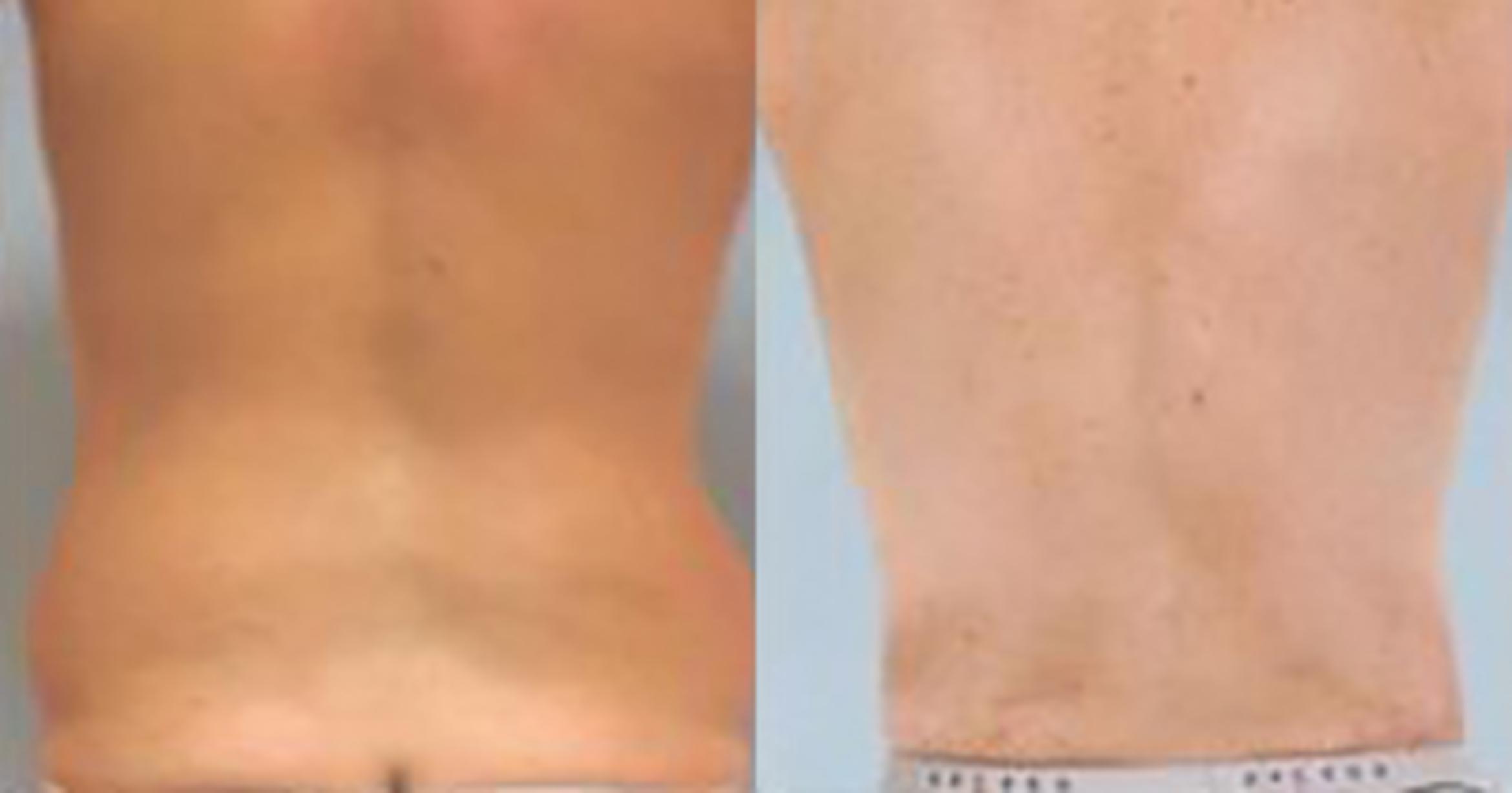 Before & After Tummy Tuck Case 362 View 4 View in Houston, TX